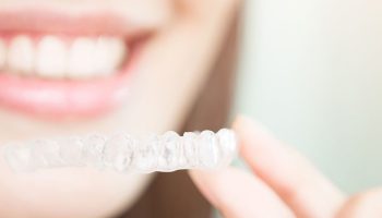 How Long Does It Take to Fix an Overbite with Clear Aligners?