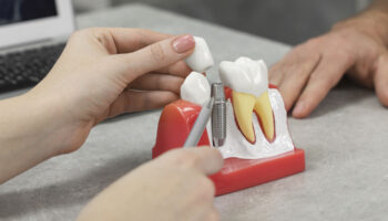 Dental Implant Process Step by Step: What to Expect